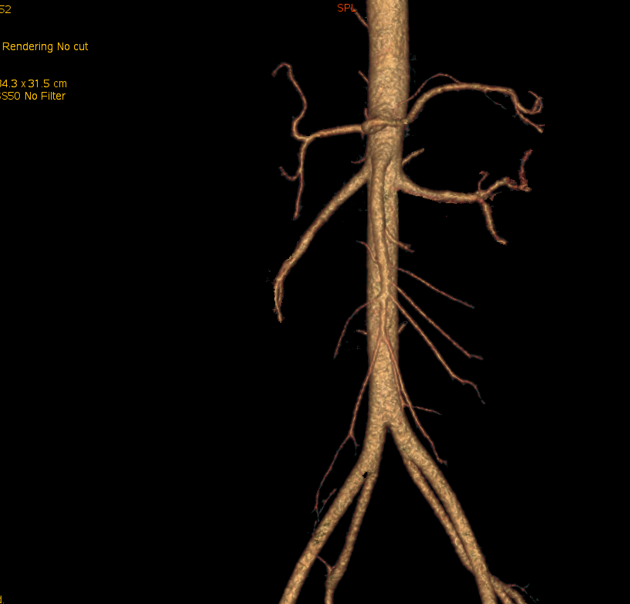 imagerie volume rendering aorte2 (2)