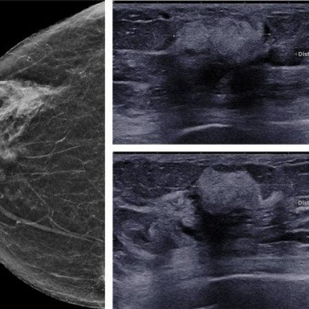 Mammographie et échographie mammaire (1)